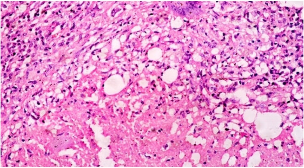 Lymph node biopsy showing epitheloid cell changes in H/E stain by 400x.