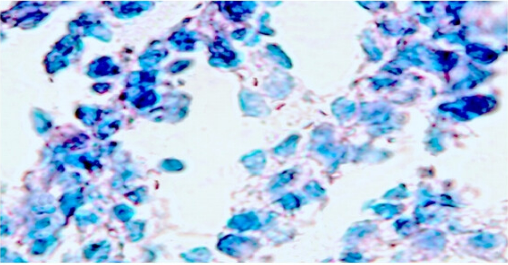 Fragmented or beaded rods (AFB) seen inside and outside macrophages in ZN staining by 400x.