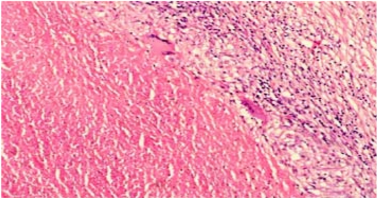 Lymphnode biopsy showing giant cells and caseation in H/E stain by 400x.